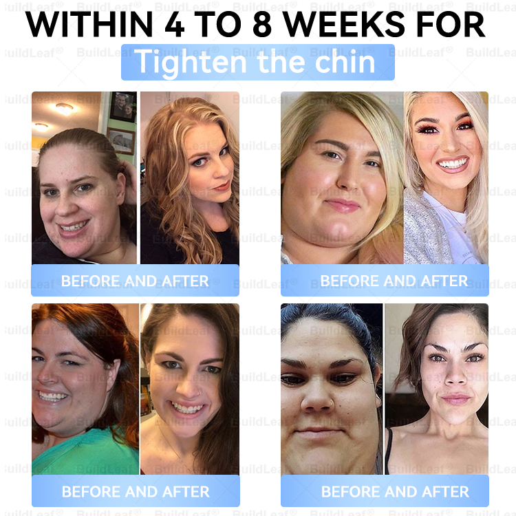 👨⚕️🏥FDA Store |𝐵uil𝗱𝐿ea𝐟® 𝑮𝐋𝑃-1 Slim & Firm 𝑁ano 𝑀icroneedle 𝑃atch with Collagen,Turmeric&Matrixyl 3000 丨Obesity,Cardiovascular Diseas, Diabetes, Sleep Apnea, Joint Problems and More