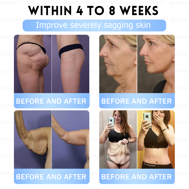 👨⚕️🏥FDA Store |𝐵uil𝗱𝐿ea𝐟® 𝑮𝐋𝑃-1 Slim & Firm 𝑁ano 𝑀icroneedle 𝑃atch with Collagen,Turmeric&Matrixyl 3000 丨Obesity,Cardiovascular Diseas, Diabetes, Sleep Apnea, Joint Problems and More