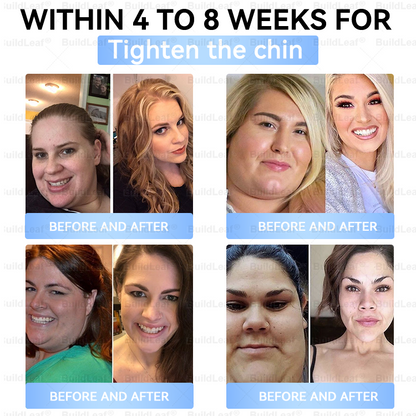 👨‍⚕️🏥FDA Store |𝐵uil𝗱𝐿ea𝐟® 𝑮𝐋𝑃-1 Slim & Firm 𝑁ano 𝑀icroneedle 𝑃atch with Collagen,Turmeric&Matrixyl 3000 丨Obesity,Cardiovascular Diseas, Diabetes, Sleep Apnea, Joint Problems and More
