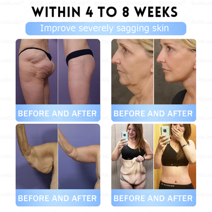 👨‍⚕️🏥FDA Store |𝐵uil𝗱𝐿ea𝐟® 𝑮𝐋𝑃-1 Slim & Firm 𝑁ano 𝑀icroneedle 𝑃atch with Collagen,Turmeric&Matrixyl 3000 丨Obesity,Cardiovascular Diseas, Diabetes, Sleep Apnea, Joint Problems and More